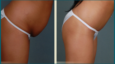 Liposuction In Ahmedabad, Hair Transplant In Ahmedabad