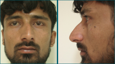 Rhinoplasty In Ahmedabad