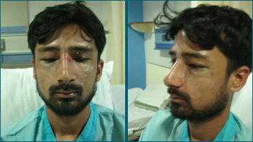 Rhinoplasty In Ahmedabad