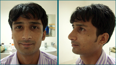 Rhinoplasty In Ahmedabad