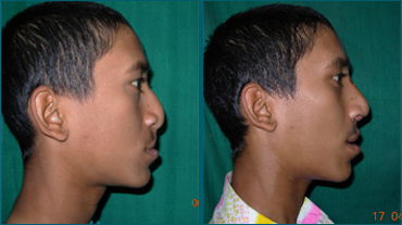 Rhinoplasty In Ahmedabad